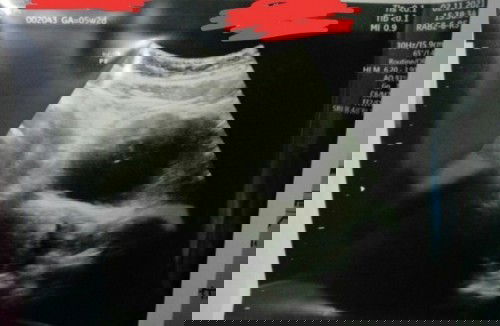 Hasil tespek negatif . UDG usia kehamilan 5week tapi masih penebalan dinding rahim