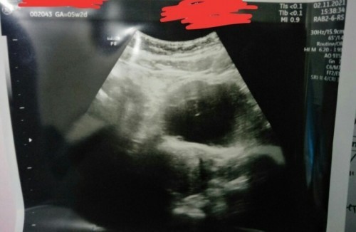 Hasil tespek negatif . UDG usia kehamilan 5week tapi masih penebalan dinding rahim