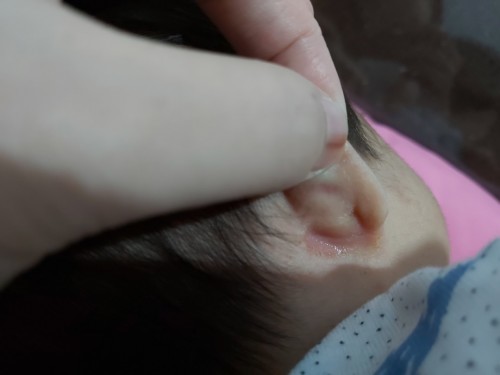 rashes sa likod ng ear