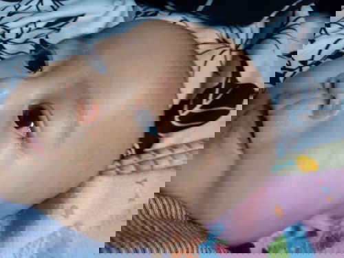 Lecet, luka pada hidung bayi