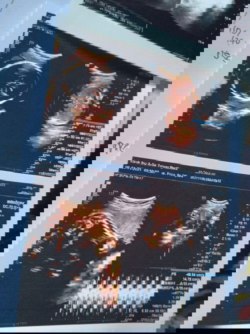 Usia janin dan usia USG berbeda