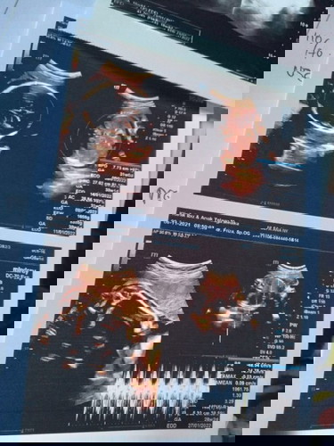 Usia janin dan usia USG berbeda