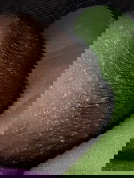 Bintik- bintik putih di kepala bayi