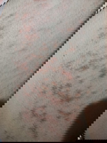Rashes on 19th week