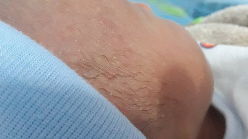 Bé e bị v là nổi hạt gì v mn e thấy bé e nổi gần trán và trên mặt những hạt trắng li ti e lo quá ạ