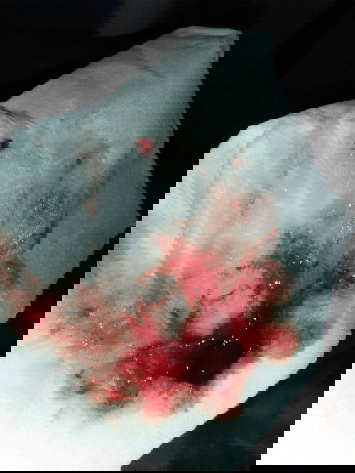 Pelebaran pembuluh darah dalam hidung