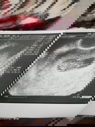 Ultrasound