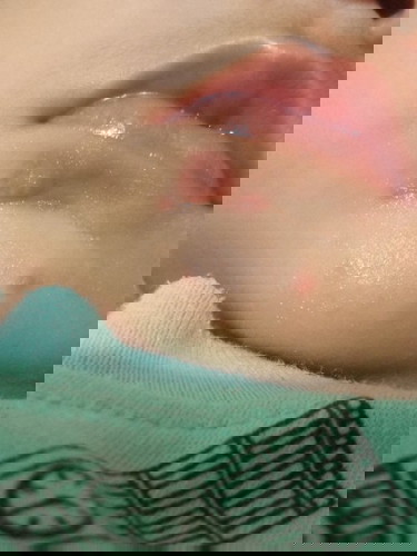 merah2 pada dagu bayi