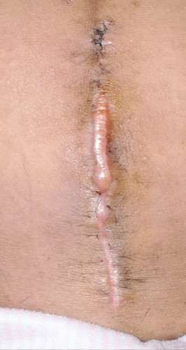 Sino po my same situation sakin cs po ako pro nagka ganito tahi ko 3weeks pa lang ako