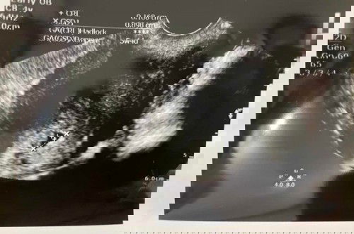 usg 6w5d belum ada denyut jantung