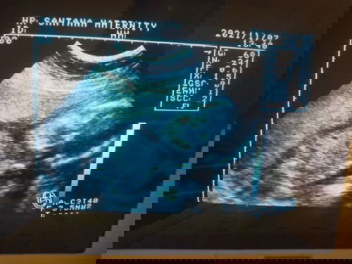 Crossed-legs at Ultrasound