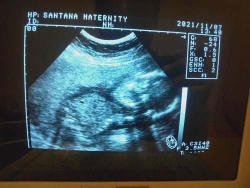 Crossed-legs at Ultrasound