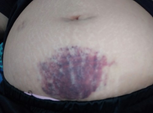 ช้ำจนน่ากลัว