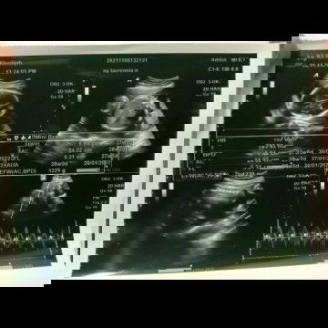 Cara membaca hasil usg