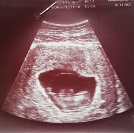 กี่เดือนคะกว่าจะรู้เพศลูก แม่อยากจะรู้ใจจะขาดแล้วค่ะตอนนี้ท้อง 12 วีค