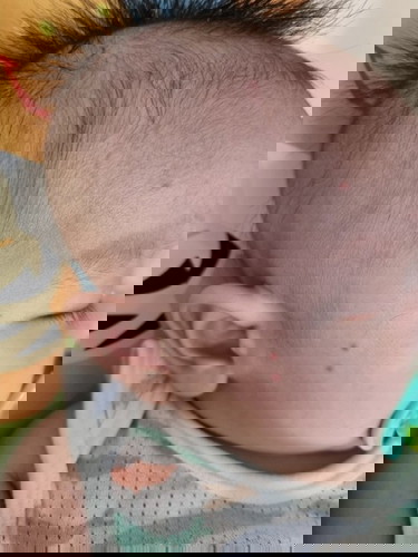 Red spots on baby's face