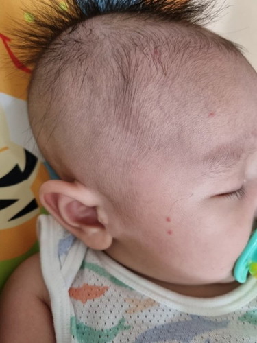 Red spots on baby's face