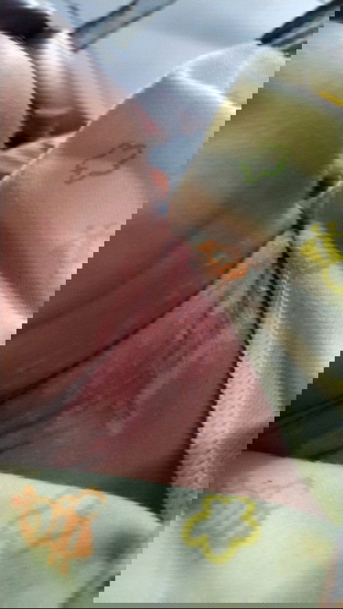 Ruam pada kulit bayi