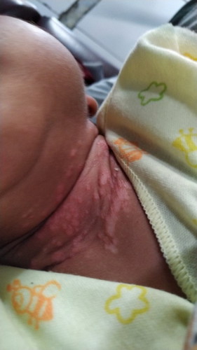 Ruam pada kulit bayi