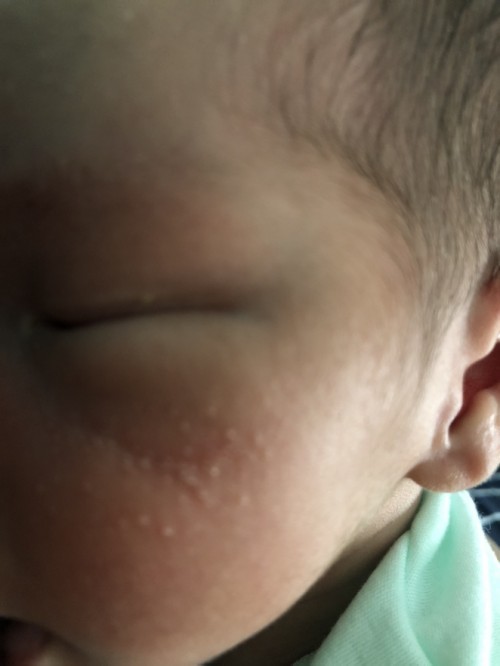 Ruam merah & bintik2 pada muka