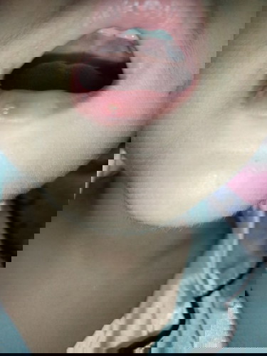 ลูกสาว2ขวบ7เดือนมีตุ๋มที่ปากขึ้นแบบนี้1อัน เป็นครั้งแรก เป็นเพราะอะไรคะ อันตรายไหม เราต้องทำยังไงดี