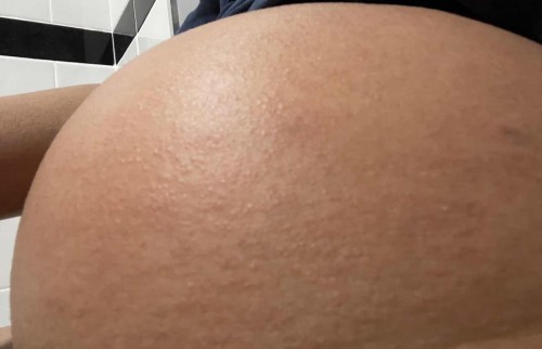 ผดขึ้นแบบนี้ปกติไหมคะ มีวิธีแนะนำไหม