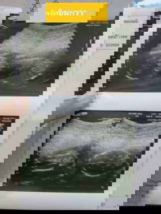 วันนึงมีคุณแม่ท่านไหนฉี่เกิน20ครั้งมั้ยค่ะ.ของฉันบ่อยมากๆเลยค่ะ.เข้า20สัปดาห์แล้วยังฉี่บ่อยอยู่เลย