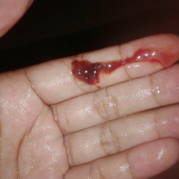 มีเลือดออกทางช่องคลอด เป็นไรไหมค่ะ ใครรู้ช่วยให้คำปรึกษาทีค่ะ#ท้องแรก