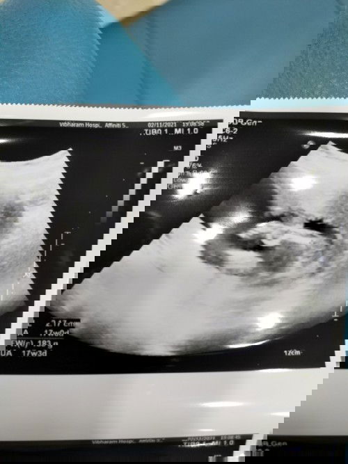 17w น้องหนีบไม่ให้เห็น