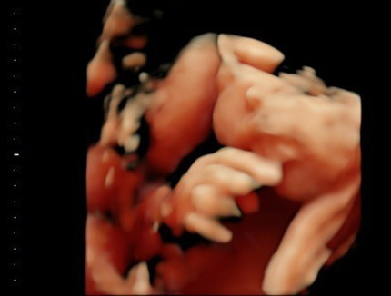 35 week Barat badan janin 2,6 kg