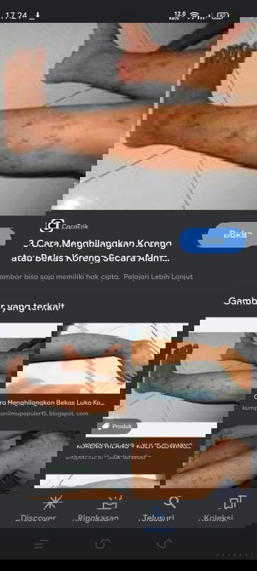 Kulit koreng karena gatal