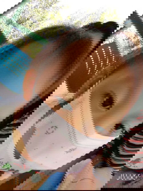 ลูกสาววัย3ขวบ6เดือนผมขาดหลุดร่วง