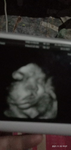 Dok kok hasil usg nya gini apa gak papa dok kok di atas mulut nya gitu dok