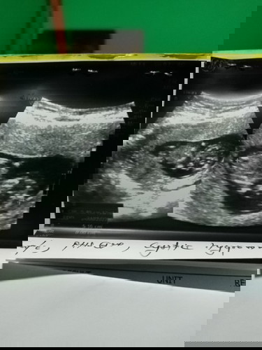 พบถุงน้ำที่ตัวน้อง 12 week 1 day