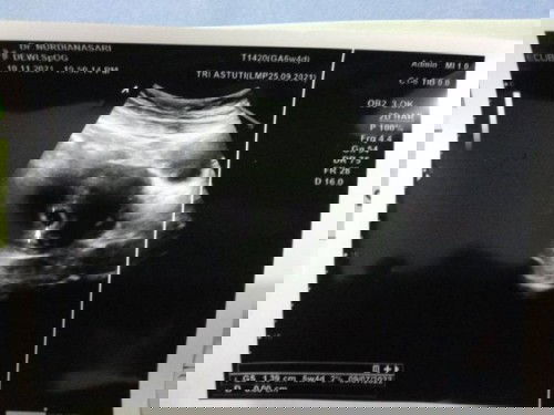 6w4d masih berbentuk kantung