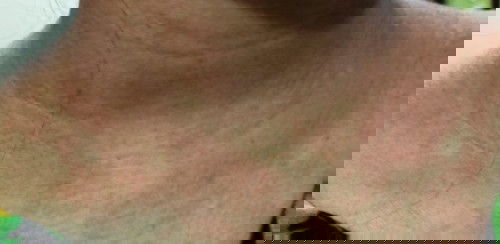 Hamil alergi minyak kayu putih