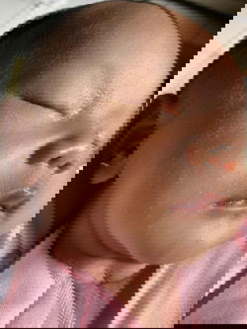 Wajah bayi bruntusan