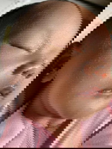 Wajah bayi bruntusan