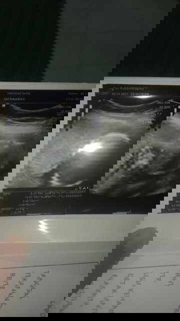 Kehamilan Trimester Kedua