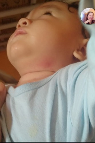 Namamagang Bukol na kulay pula.