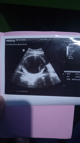 Bun mau Nanya kemarin USG bidan ya bilang dikepala Bayi anak sya tidak kliatan garis sutura kenapaya