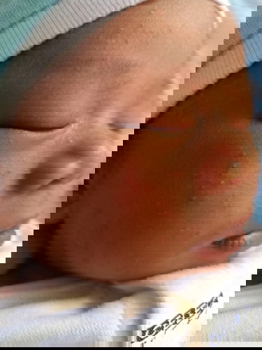 Pula o butlig2x sa mukha ni baby