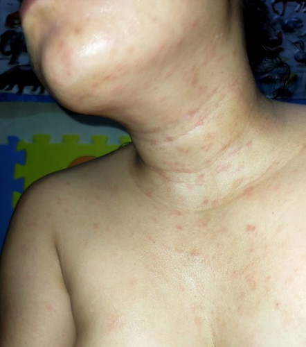 skin rash ? allergy?