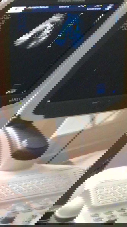 Bayiku Sehat walaupun terlilit 2tali pusat