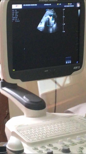 Bayiku Sehat walaupun terlilit 2tali pusat