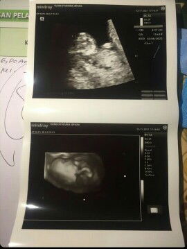 Tentang usg janin