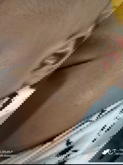 persoalan kulit bayi