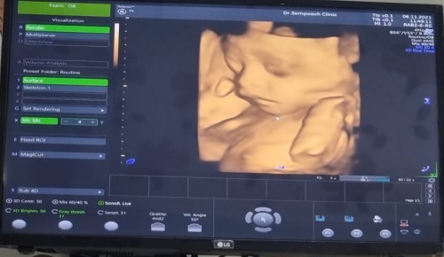 27wk แล้วครับ