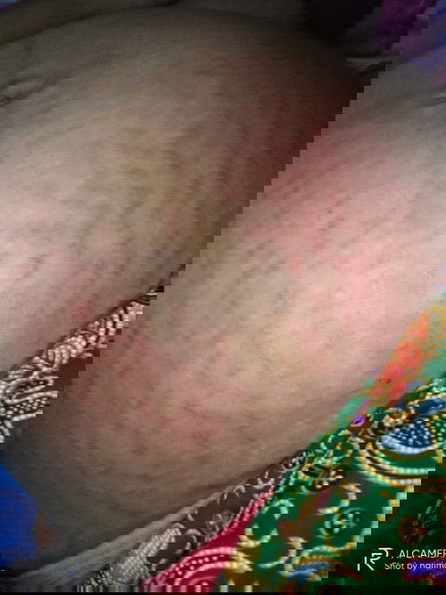 เป็นผื่นคัน ขอวิธีบรรเทาหน่อยค่ะ