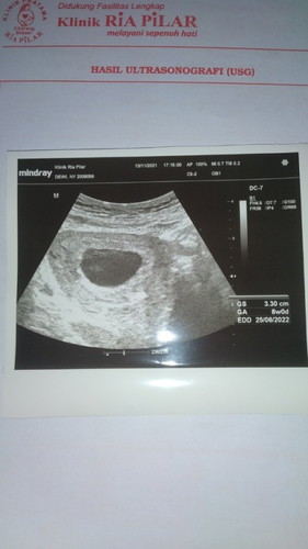 8 minggu belum terlihat janin